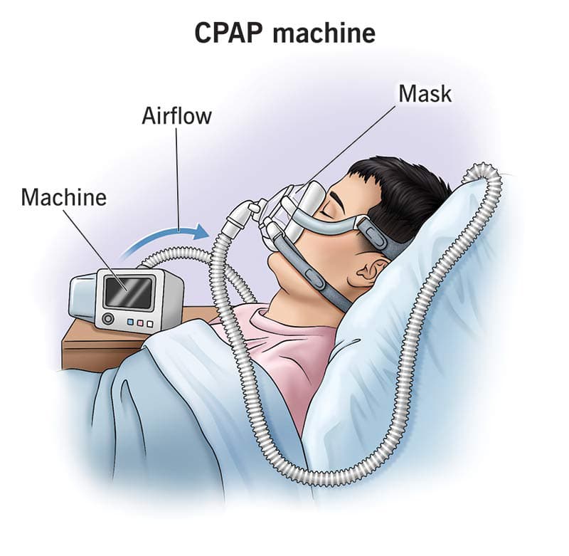 Jenseits von CPAP: Neue operative Behandlungen & „Schrittmacher“
